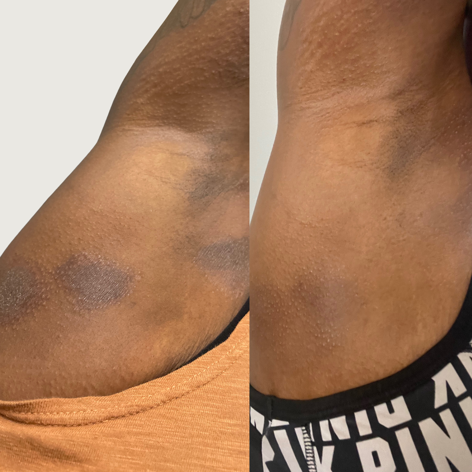 Eczema, Redness, Dry & Itchiness