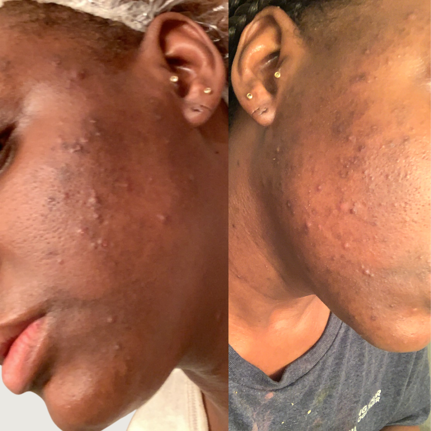 Fading Dark Spots & Acne Routine Bundle